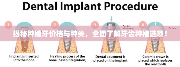 揭秘种植牙价格与种类，全面了解牙齿种植选项！